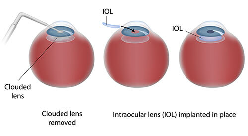 IOL implantation diagram