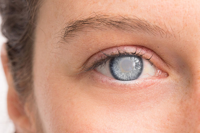 Close-up of an eye with cataract
