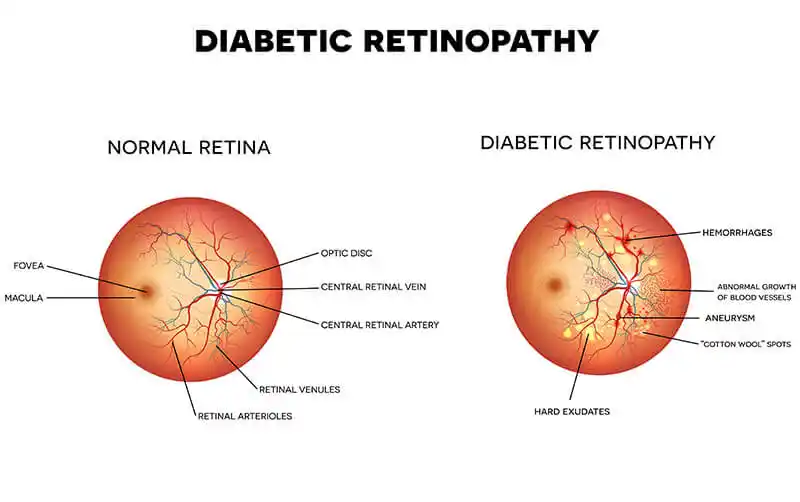 Diabetic retinopathy diagram