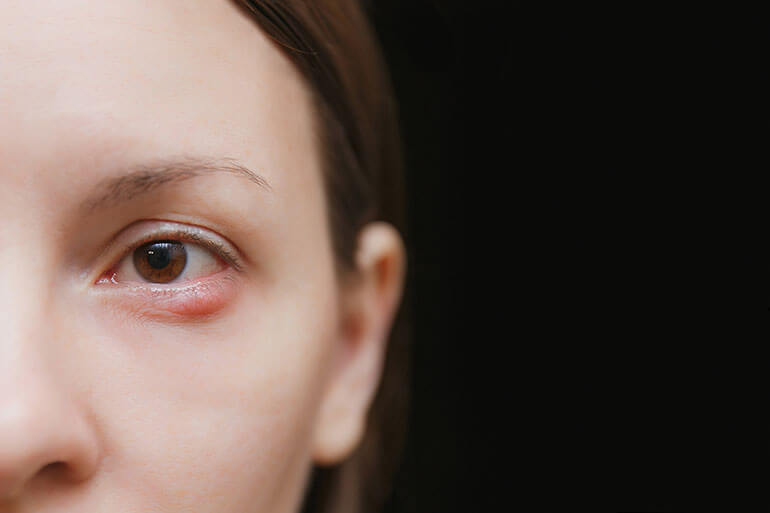 Eyelid procedure care