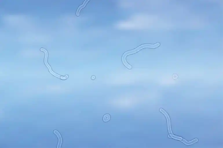 Eye floaters and flashes
