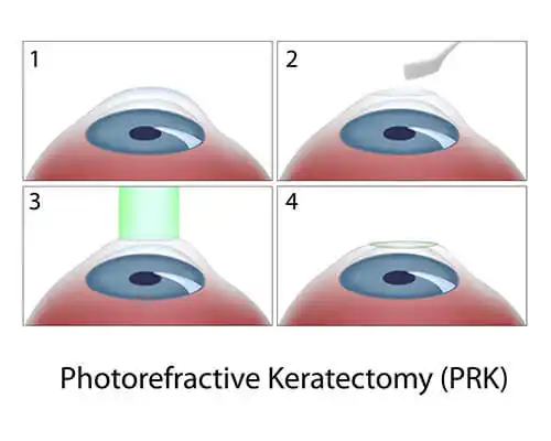 PRK procedure diagram