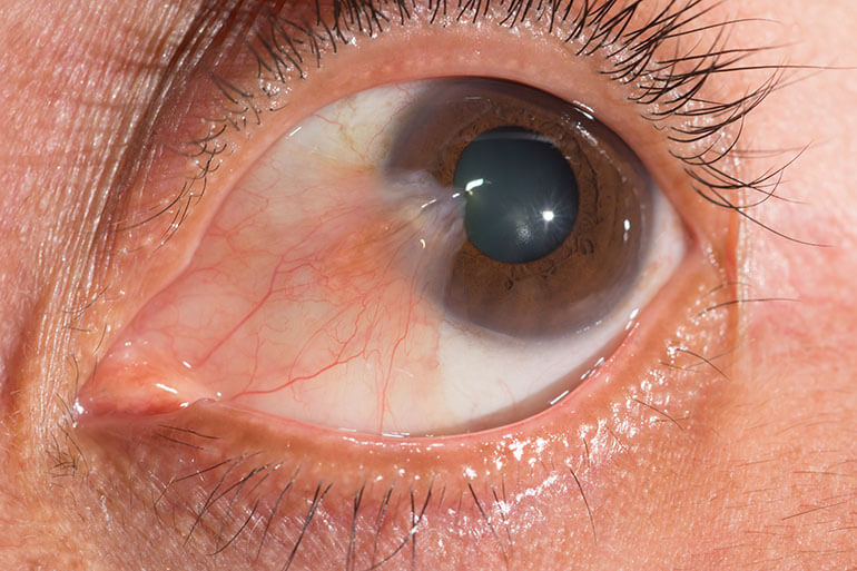Pterygium and pingueculum eye conditions